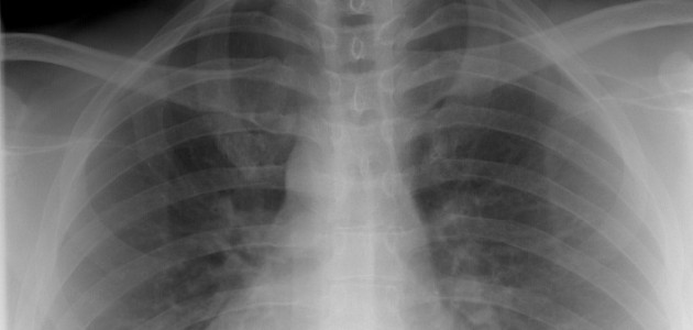 Need an x-ray? Walk-ins are now allowed at MAHC sites