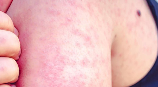 Health unit announces new measles exposure sites and community immunization clinics